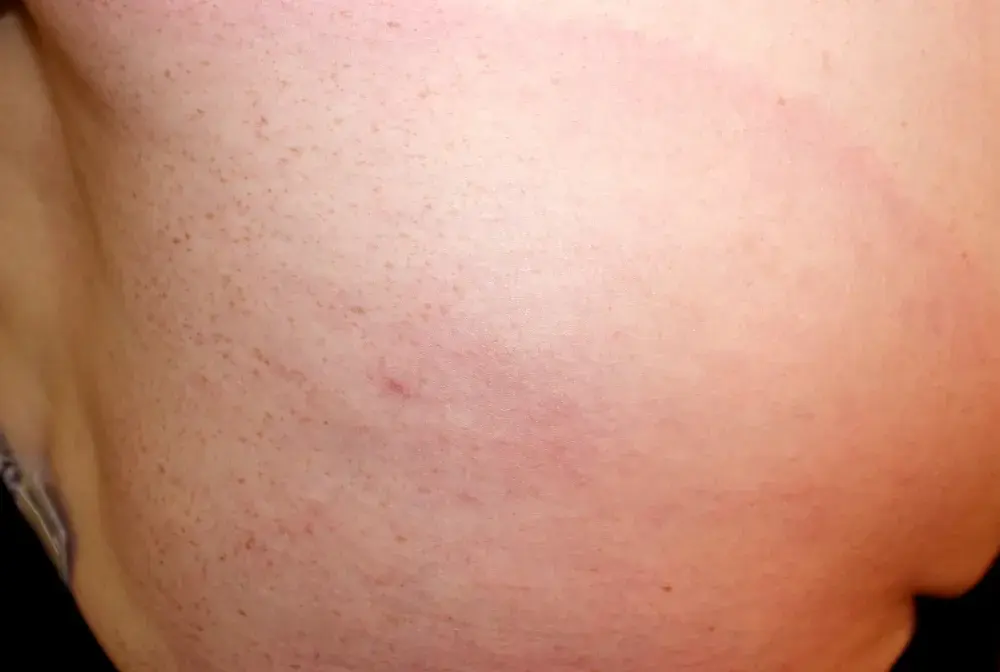 Alergia po kleszczu - Jak rozpoznać i kiedy działać?