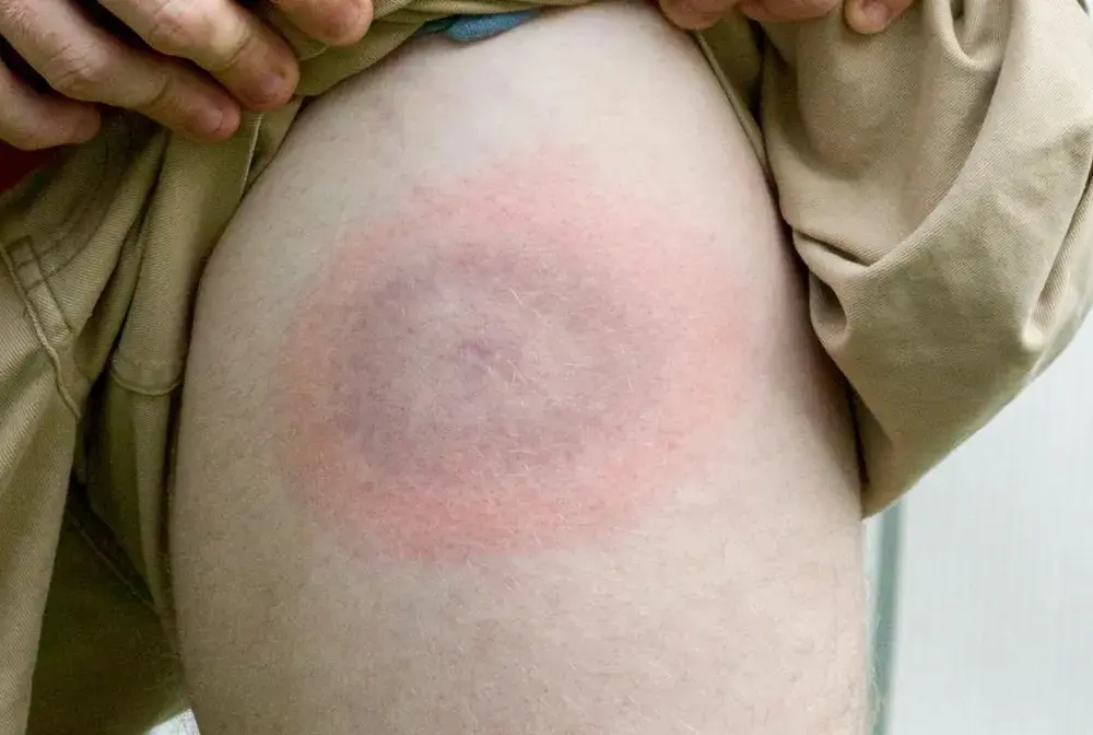 Rumień wędrujący czy alergia po kleszczu? Rozpoznaj objawy