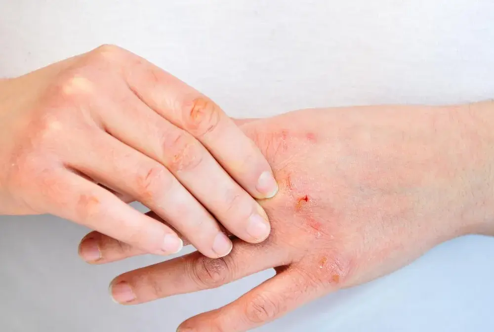 Trazodon a alergia - Rozpoznaj objawy i reaguj!