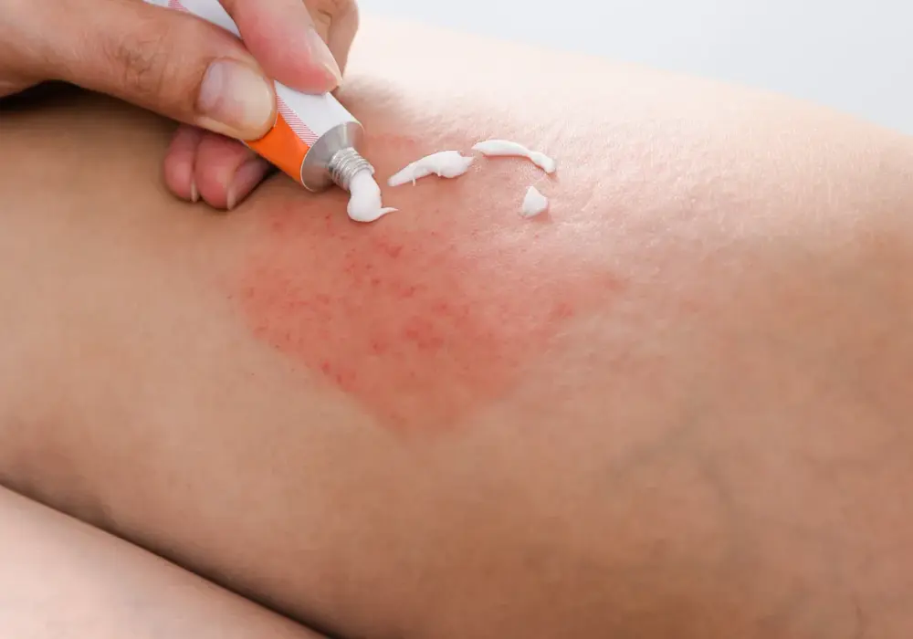 Ugryzienie mrówki - Alergia czy zwykła reakcja? Sprawdź!