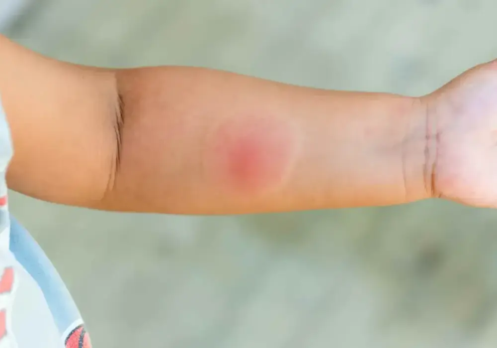 Opuchlizna po ukąszeniu owada - kiedy to alergia, a kiedy infekcja?