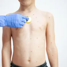 Dłoń w niebieskiej rękawiczce bada klatkę piersiową chłopca z licznymi czerwonymi kropkami, wskazującymi na ospa początki.