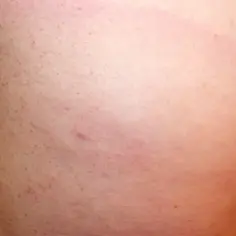 Skóra z drobnymi krostkami i zaczerwienieniem, sugerujące odczyn alergiczny po kleszczu.