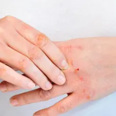 Dłoń z suchą, łuszczącą się skórą i zadrapaniami. Może to być skutek uboczny leku trazodone neuraxpharm 50 mg.
