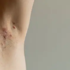 Skóra pod pachą z widocznymi zmianami zapalnymi, które mogą wskazywać na trądzik odwrócony.