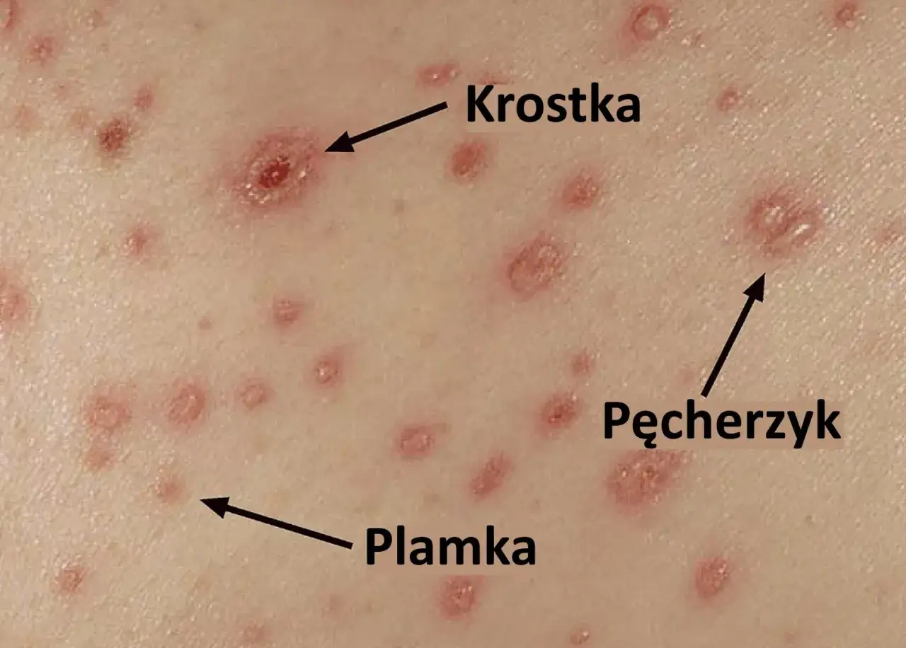 Początki ospy: widoczne plamki, krostki i pęcherzyki na skórze.