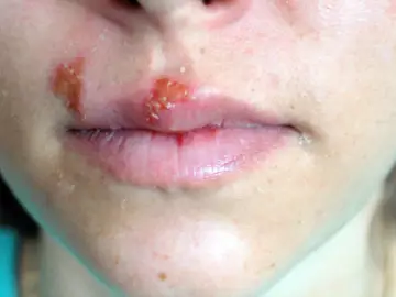 Zmiany skórne wokół ust, przypominające afty. Przyczyny mogą być różne, od infekcji po reakcje alergiczne.