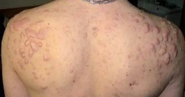 Trądzik na plecach - Skuteczna pielęgnacja i kiedy do lekarza?