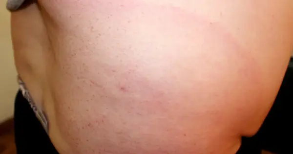 Alergia po kleszczu - Jak rozpoznać i kiedy działać?