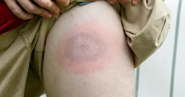 Rumień wędrujący czy alergia po kleszczu? Rozpoznaj objawy
