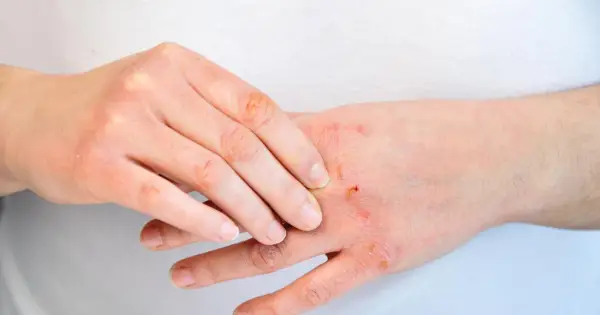 Trazodon a alergia - Rozpoznaj objawy i reaguj!
