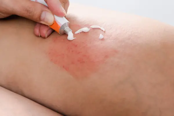 Ugryzienie mrówki - Alergia czy zwykła reakcja? Sprawdź!
