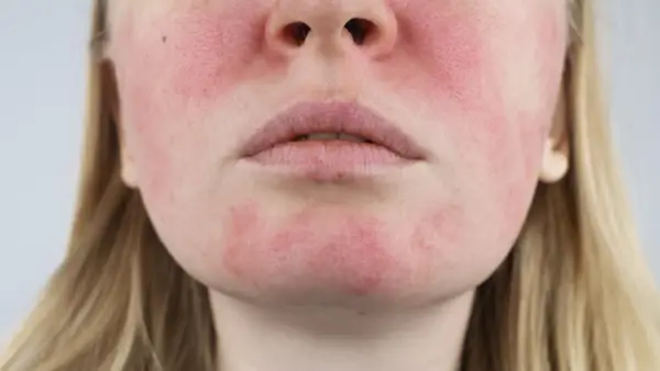 Reakcja na aspirynę - alergia czy nadwrażliwość? Sprawdź!