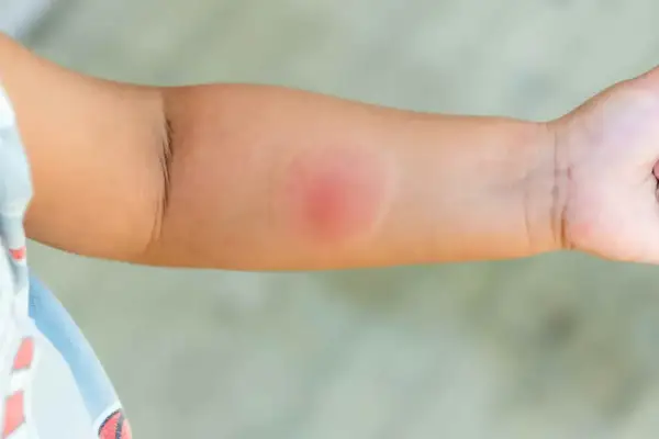Opuchlizna po ukąszeniu owada - kiedy to alergia, a kiedy infekcja?