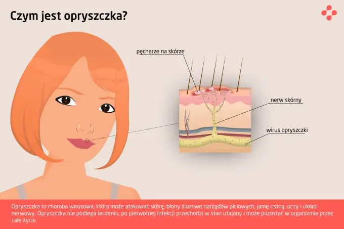 Opryszczka - pierwsze objawy i co robić, by szybko zwalczyć?