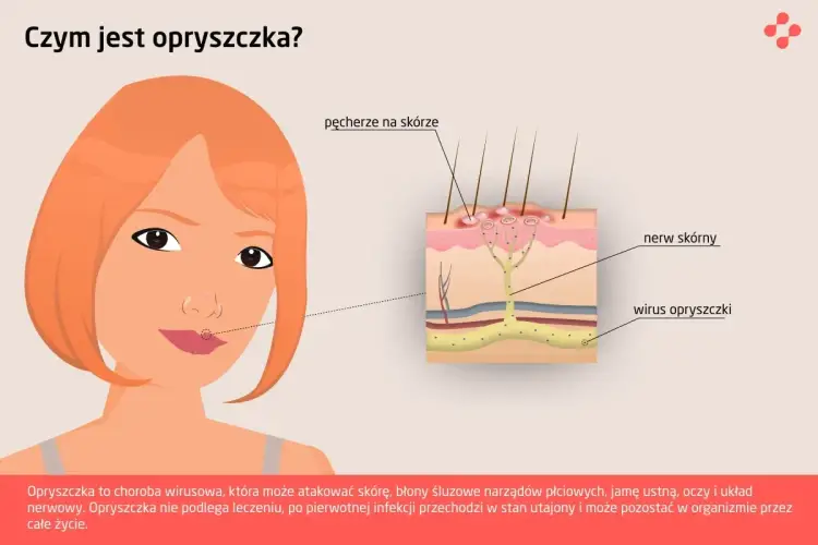 Opryszczka - pierwsze objawy i co robić, by szybko zwalczyć?